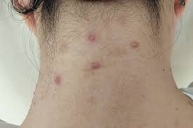 Neck Acne