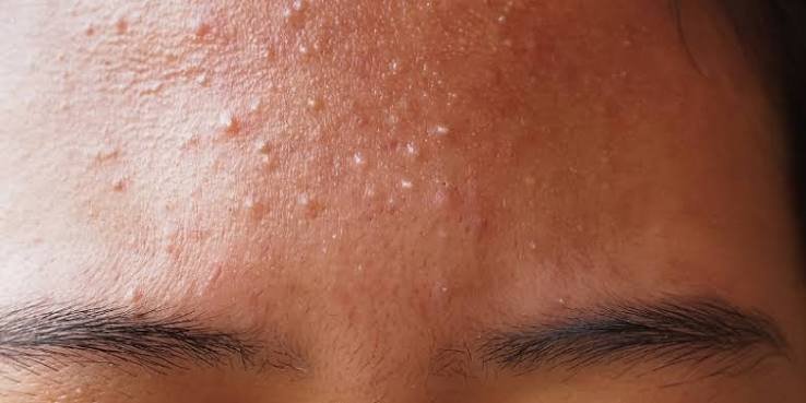 Forehead Acne and Pimples: Types, Causes, Treatments, and Daily Routine
